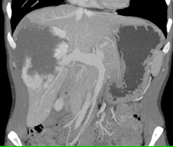 Hemangioma - CTisus CT Scan