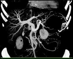 Cirrhosis With Varices - CTisus CT Scan