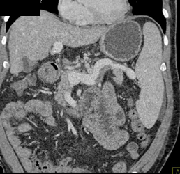 Partial Splenic Vein Occlusion Due to Portal Hypertension - CTisus CT Scan