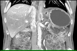 Radiation Changes in Liver Due to Therapy for Pancreatic Cancer in Patient S/P Whipple Procedure - CTisus CT Scan