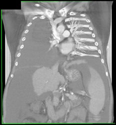 Gynecomastia Due to Cirrhosis - CTisus CT Scan