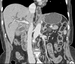 Portal Vein Encased By Gallbladder Cancer - CTisus CT Scan