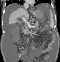 Clot in Portal Vein in Patient With Cirrhosis - CTisus CT Scan