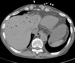 Air in Hepatic Veins Due to Ischemic Bowel With Pneumatosis of the Right Colon - CTisus CT Scan