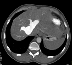 Reflux of Contrast Into the IVC and Hepatic Veins Due to Poor Cardiac Function - CTisus CT Scan