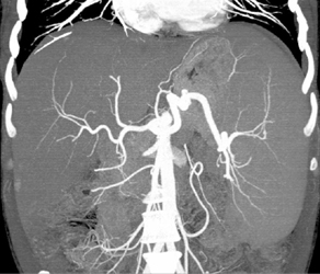 Splenomegaly - CTisus CT Scan