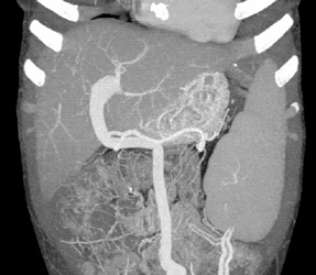 Dilated Umbilical Vein in Portal Hypertension With Splenomegaly - CTisus CT Scan