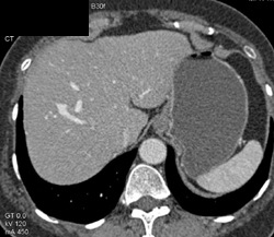 Av Shunt - CTisus CT Scan