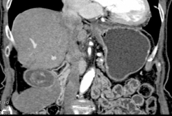 Av Shunt Plus Large Gallstones - CTisus CT Scan