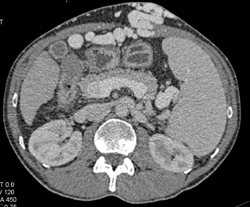 Cirrhosis With Large Varices and Portal Hypertension - CTisus CT Scan