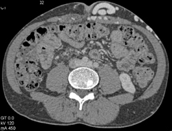 Cirrhosis With Large Varices and Portal Hypertensio - CTisus CT Scan