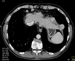 Carcinoid With Implants in the Liver - CTisus CT Scan