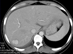 Focal Nodular Hyperplasia (FNH) - CTisus CT Scan