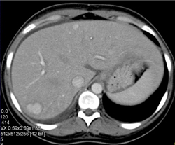 Focal Nodular Hyperplasia (FNH) - CTisus CT Scan