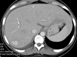 Focal Nodular Hyperplasia (FNH) - CTisus CT Scan