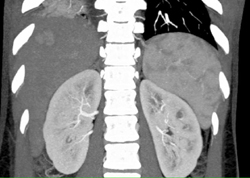 Focal Nodular Hyperplasia (FNH) - CTisus CT Scan