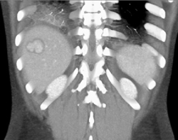 Focal Nodular Hyperplasia (FNH) - CTisus CT Scan