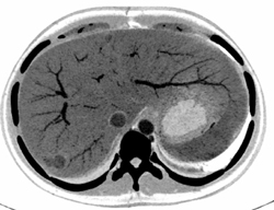 Focal Nodular Hyperplasia (FNH) - CTisus CT Scan