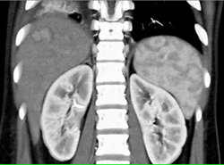 Focal Nodular Hyperplasia (FNH) - CTisus CT Scan