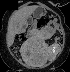 Hepatoma and Uterine Fibroids - CTisus CT Scan