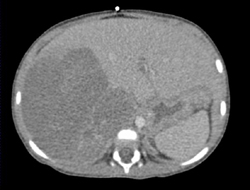 Melanoma With Liver Metastases - CTisus CT Scan