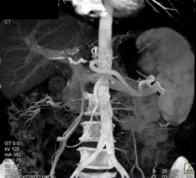 Hepatic Artery Stenosis S/P Transplant - CTisus CT Scan