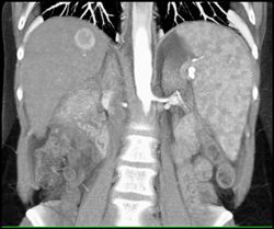 Hepatoma in A Cirrhotic Liver - CTisus CT Scan