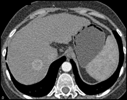 Hepatoma in A Cirrhotic Liver - CTisus CT Scan