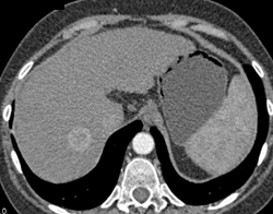 Hepatoma in A Cirrhotic Liver - CTisus CT Scan