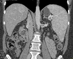 Hepatoma in A Cirrhotic Liver - CTisus CT Scan