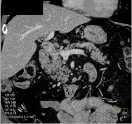 Stone in Thickened and Inflamed Common Bile Duct (CBD) - CTisus CT Scan