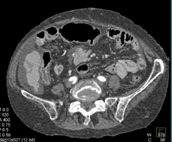 Liver Metastases From A Carcinoid Tumor-see Mesentery - CTisus CT Scan