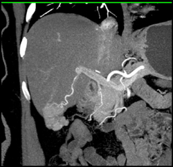 Focal Nodular Hyperplasia (FNH) - CTisus CT Scan