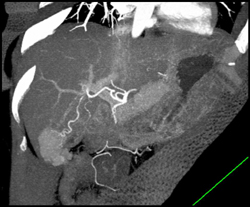 Focal Nodular Hyperplasia (FNH) - CTisus CT Scan