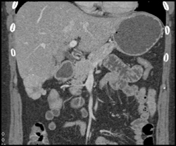 Focal Nodular Hyperplasia (FNH) - CTisus CT Scan