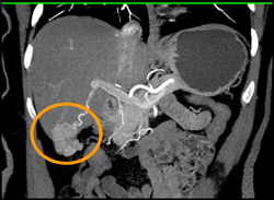 Focal Nodular Hyperplasia (FNH) - CTisus CT Scan