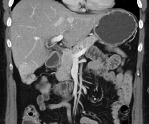 Focal Nodular Hyperplasia (FNH) - CTisus CT Scan