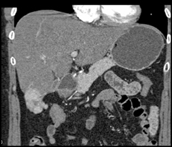 Focal Nodular Hyperplasia (FNH) - CTisus CT Scan