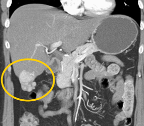 Focal Nodular Hyperplasia (FNH) - CTisus CT Scan