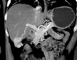 Focal Nodular Hyperplasia (FNH) - CTisus CT Scan