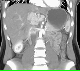 Focal Nodular Hyperplasia (FNH) - CTisus CT Scan