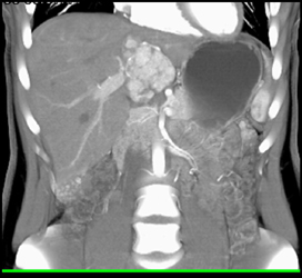 Focal Nodular Hyperplasia (FNH) - CTisus CT Scan