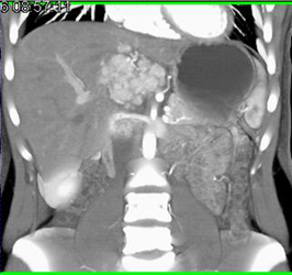 Focal Nodular Hyperplasia (FNH) - CTisus CT Scan