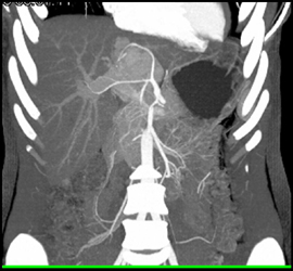 Focal Nodular Hyperplasia (FNH) With Stretched Hepatic Artery - CTisus CT Scan