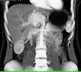 Focal Nodular Hyperplasia (FNH) - CTisus CT Scan