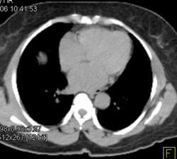 Hepatoma Involves Lvc Only on Internal Phase Study-nice PET-ct Correlation - CTisus CT Scan