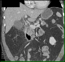 Stones in Common Bile Duct (CBD) - CTisus CT Scan