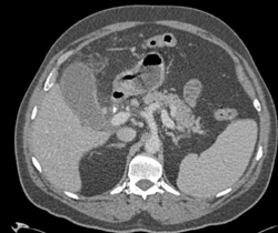 Inflammation Around Hdj??? - CTisus CT Scan