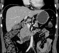 Gallstones and Mass in Gallbladder - CTisus CT Scan