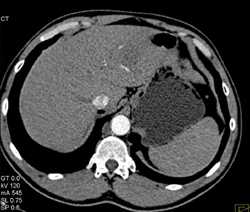 Arterial Phase Liver - CTisus CT Scan